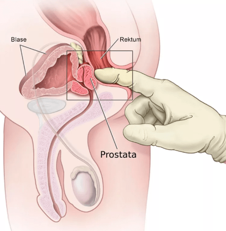 Masaje de próstata